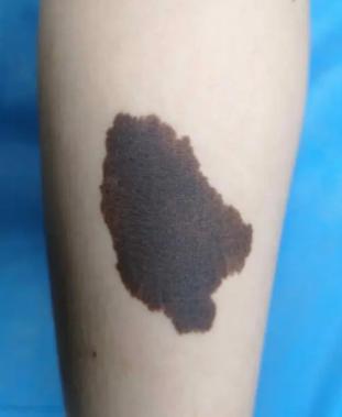 出彩速配 长在这3个位置的痣，癌变系数「飙升」！大人孩子都得小心！