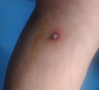 名鼎配资 被蜱虫咬后千万不要硬拔 要及时就医